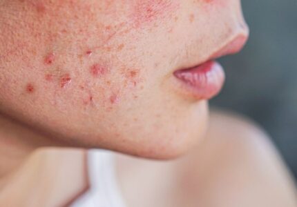 Acne ( मुंहासे)