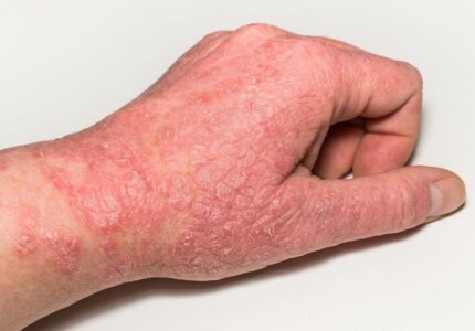 Dermatitis (त्वचाशोथ )