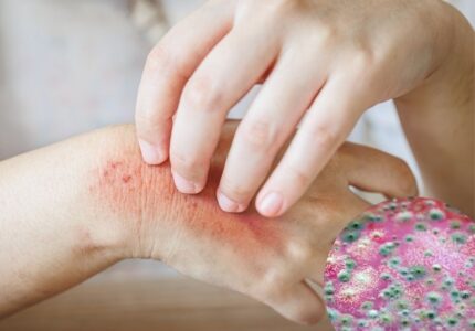Fungal infection (कवक संक्रमण)