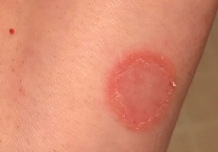 Ringworm (दाद )