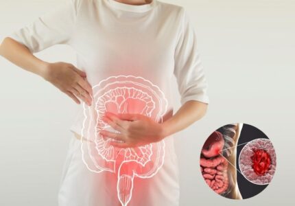 Ulcerative Colitis (अल्सरेटिव कोलाइटिस)