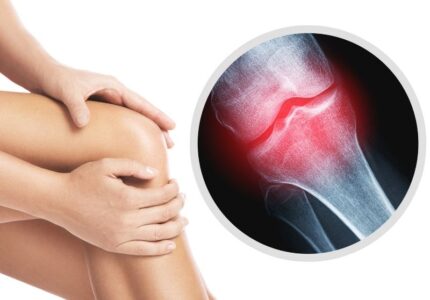 Osteoarthritis / गठिया 