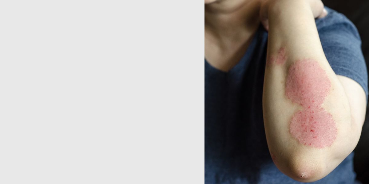 Skin Disease
