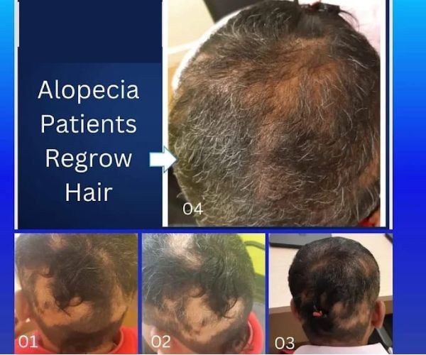 Alopecia Treatment Result