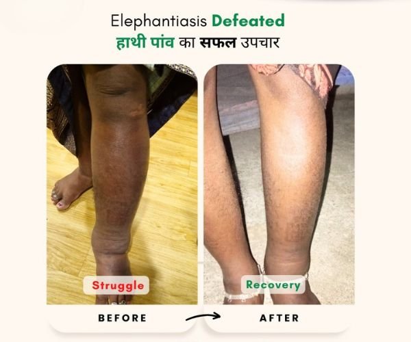 Elephantitis Treatment Result