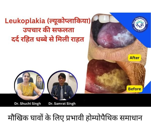 Leukoplakia Treatment Result