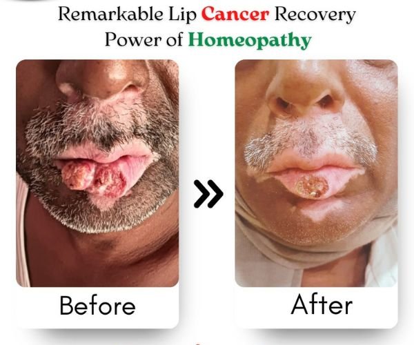 Lip Cancer Treatment Result