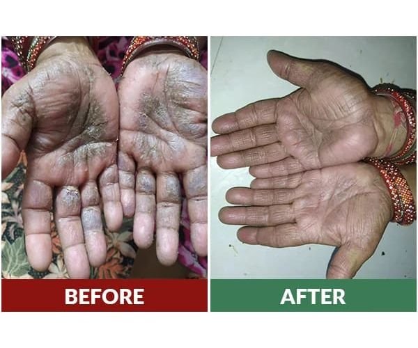 Psoriasis Treatment Result 1