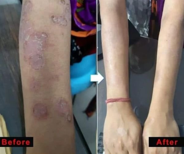 Psoriasis Treatment Result 2